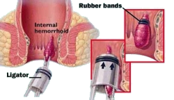 Hemorrhoid Removal - Non Surgical